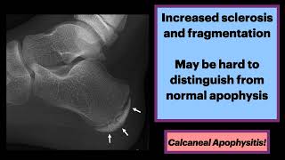 Calcaneal Apophysitis MSK Radiology Orthopedics [upl. by Merrel]