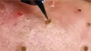 Full Giant Blackheads Popping Video Blackheads Removal 2019 [upl. by Enrobso]