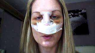 Septoplasty Recovery  Day 4 revision [upl. by Cadal802]