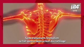 LA MINUTE SANTE  La polyarthrite rhumatoïde origines symptômes et traitements [upl. by Aretta]