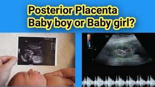 Posterior placenta Baby boy or Baby Girl Gender Prediction Radiology vibes [upl. by Nepil]