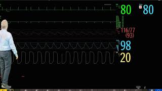 Philips IntelliVue Patient Monitoring  1  Introduction to Basic Operation [upl. by Baese767]