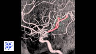 Interventional Stroke Rounds  Stroke Reversal with Penumbra [upl. by Leerzej]