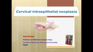 Cervical intraepithelial neoplasia [upl. by Nnoved]