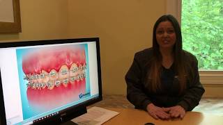 Decalcification of Teeth During Orthodontic Treatment [upl. by Gayla]