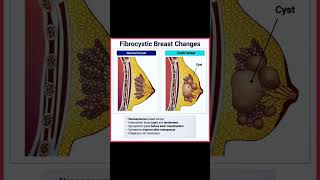 Fibrocystic breast changes medschool explore viralvideo [upl. by Akit618]