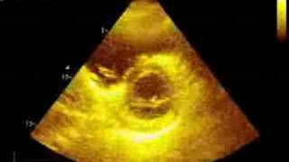 Pulmonary embolism echocardiography [upl. by Wolbrom607]