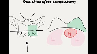 Breast Cancer Survival Rates Explained [upl. by Callum]