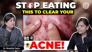 How to get rid of Acne  Acne Treatment  Acne hone par kya khana chahiye  Dr Nivedita Dadu [upl. by Nets]