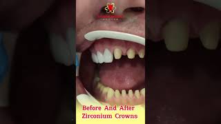 Before and After Zirconium Crowns dentist dental [upl. by Wardle]