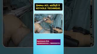 Knee pain amp instability  ACL tear surgery  New technique with keyhole Arthroscopy shorts acl [upl. by Ashla969]