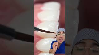 Vean esta forma de hacer carillas dentales 😨 ¿Tú teo harias dentista shorts [upl. by Koch66]