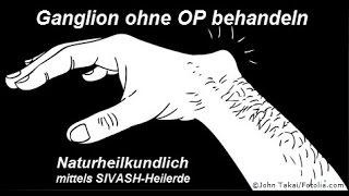 Überbein Ganglion ohne OP behandeln [upl. by Nonnahs216]