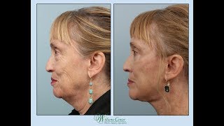 Facelift Experience by Nancy with Dr Edwin Williams [upl. by Niarfe197]