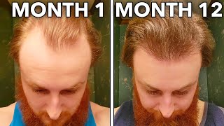 How To Reverse Hair Loss In 12 Months [upl. by Jacklin]