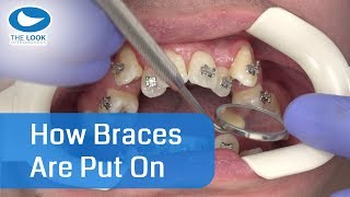 How braces are put on  AMAZING   Now with 12 month  Progress  httpsgoogljXaY15 [upl. by Yeldahc]