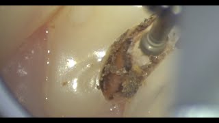 Caries Removal and indirect pulp capping [upl. by Shaughn]