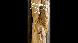 Popliteal fossa Dissection of popliteal fossa Anatomy of popliteal fossa Contents popliteal fossa [upl. by Marwin]