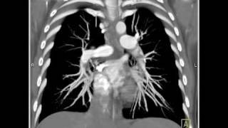 Lung Anatomy Pulmonary Embolism VRT [upl. by Ahsaeym205]