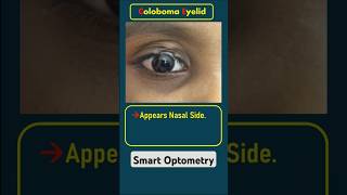 Eyelid Coloboma optometry optometrist optometrists optometrista eyedisease eyediseases eyelid [upl. by Asyen33]