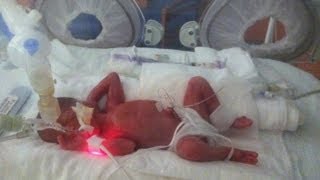 Born at 25 Weeks MicroPreemie Documentary [upl. by Sondra]