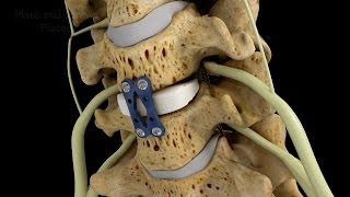 C45 Anterior Cervical Diskectomy with Fusion [upl. by Urial747]