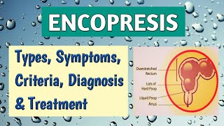 Encopresis Symptoms Types Criteria Diagnosis DD amp Management  Pediatrics [upl. by Iramo]