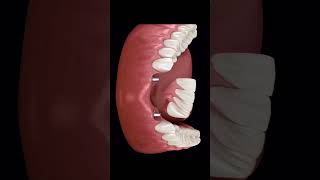 Implant supported removable partial denture RPD [upl. by Atirys]