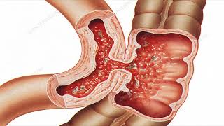 Crohns disease এর গ্রেডিং। health crohns crohnsandcolitis crohnsdisease crohn [upl. by Sahpec691]