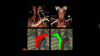 COMO FAZER ANGIOTOMOGRAFIA DE CAROTIDAS [upl. by Eceerehs]