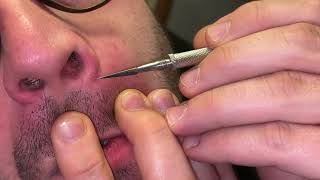 How to remove blackheads and whiteheads using a whitehead remover DIY [upl. by Assanav]