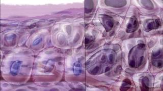 Progression of Conjunctival Intraepithelial Neoplasia [upl. by Nitza]