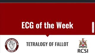 ECG of the Week Tetralogy of Fallot [upl. by Aneri227]