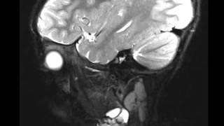 Venolymphatic Malformation [upl. by Ballman]