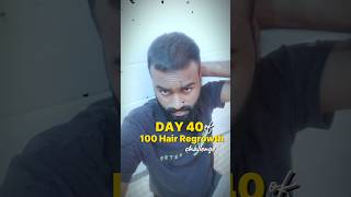 Day 40  100 Day Hair Regrowth challenge hairfall hairregrowthtreatment hairloss [upl. by Ahens]