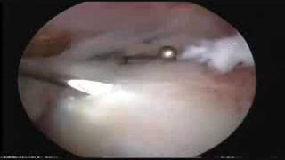 Arthroscopic Release of Calcific Deosit of Shoulder [upl. by Arodal]