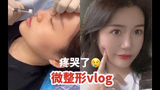 【整形vlog】玻尿酸鼻子丰唇 ｜疼哭了！！微整形经验分享 [upl. by Kelton]