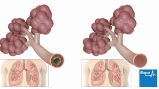 How pneumonia affects the lungs  Bupa Health [upl. by Wanyen]