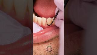 ASMR teeth scaling at the dentist shorts [upl. by Idrahs]