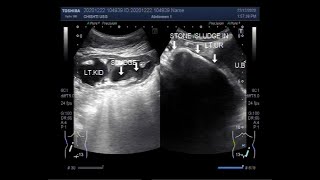 Ultrasound Video showing Pyonephrosis associated with pyoureter [upl. by Lynd531]