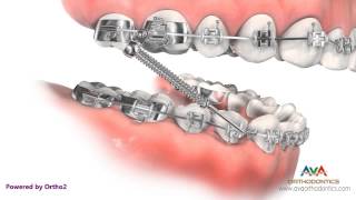 Orthodontic Treatment for Overjet Overbite  Forsus Appliance [upl. by Iccir263]