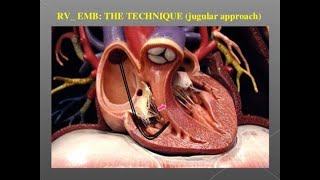 Endomyocardial Biopsy WACP Exam  Cardiology [upl. by Ennobe]