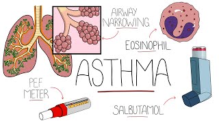 Asthma Explained Including Pathophysiology [upl. by Safire]