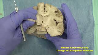 Coronal forebrain first videoneuroanatomy forebrainhypothalamushumanbrainbrainhumanbrain [upl. by Enisamoht]