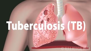 Tuberculosis TB Progression of the Disease Latent and Active Infections [upl. by Alidis]