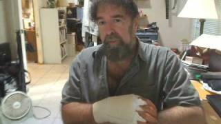 Trigger Finger Surgery PostOP aftermath  explained by Mickey Stein Trigger Finger Part 2 [upl. by Jehias]