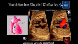 Fetal Echocardiography Ventricular Septal Defects [upl. by Ecirtram]