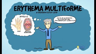 Erythema multiforme [upl. by Nylkaj]