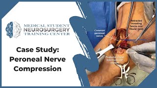 Case Study Peroneal Nerve Compression [upl. by Ydneh]