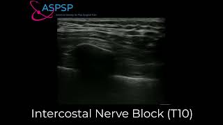 Intercostal Nerve Block for Shingles Pain [upl. by Navonod]